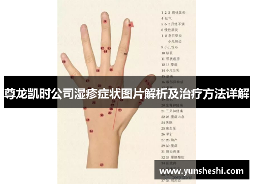 尊龙凯时公司湿疹症状图片解析及治疗方法详解