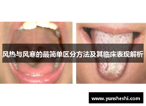风热与风寒的最简单区分方法及其临床表现解析